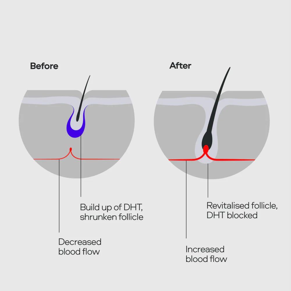 Diagram showing a before and after comparison of hair follicles with DHT buildup and blocked revitalization.